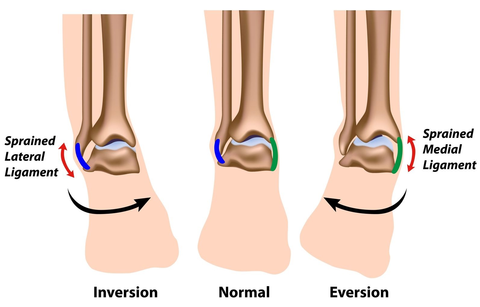 Eversion sprain/strain of the ankle joint involves the ligaments