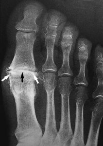 Big Toe Osteoarthritis