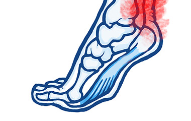 Ankle Strains