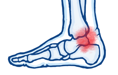 3. Ankle Sprains