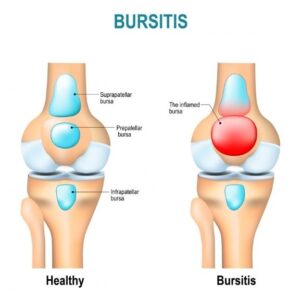 Bursitis and Kneecap or Patella pain Buxton and BAKEWELL oSTEOPATHY cLINIC