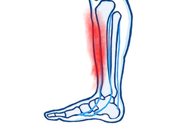 Pain in the Shin Bone (Shin Splints)