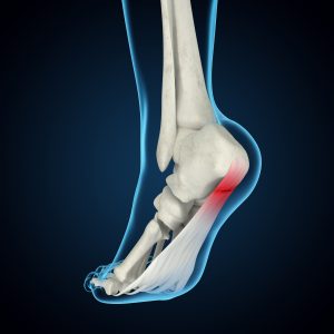 heel pain treatment Derbyshire and Peak District | Buxton Osteopathy Clinic