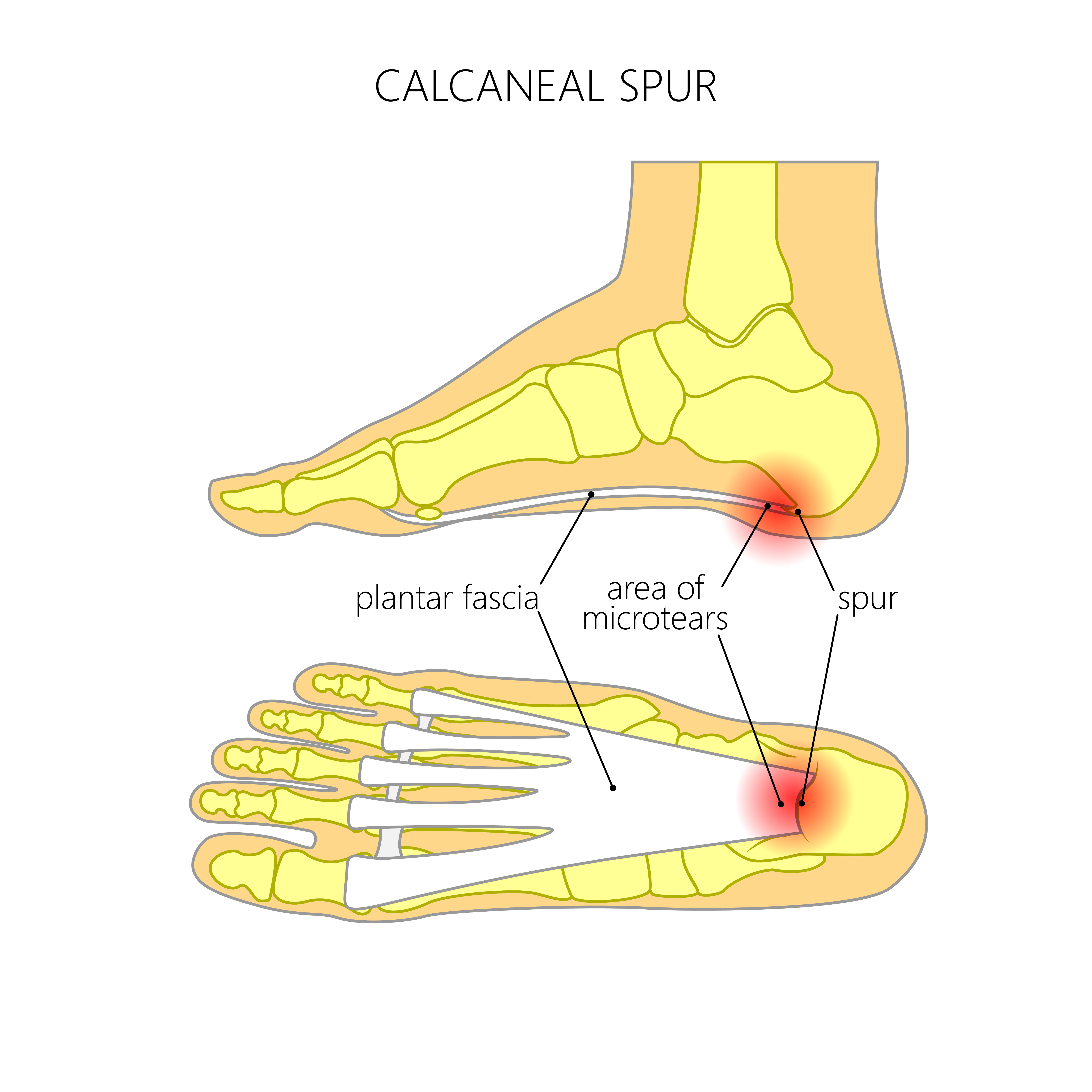 Heel Spur Surgery Recovery Time: [Is It Worth Doing the Surgery?]