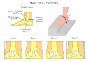 Ankle Sprain Eversion Treatment