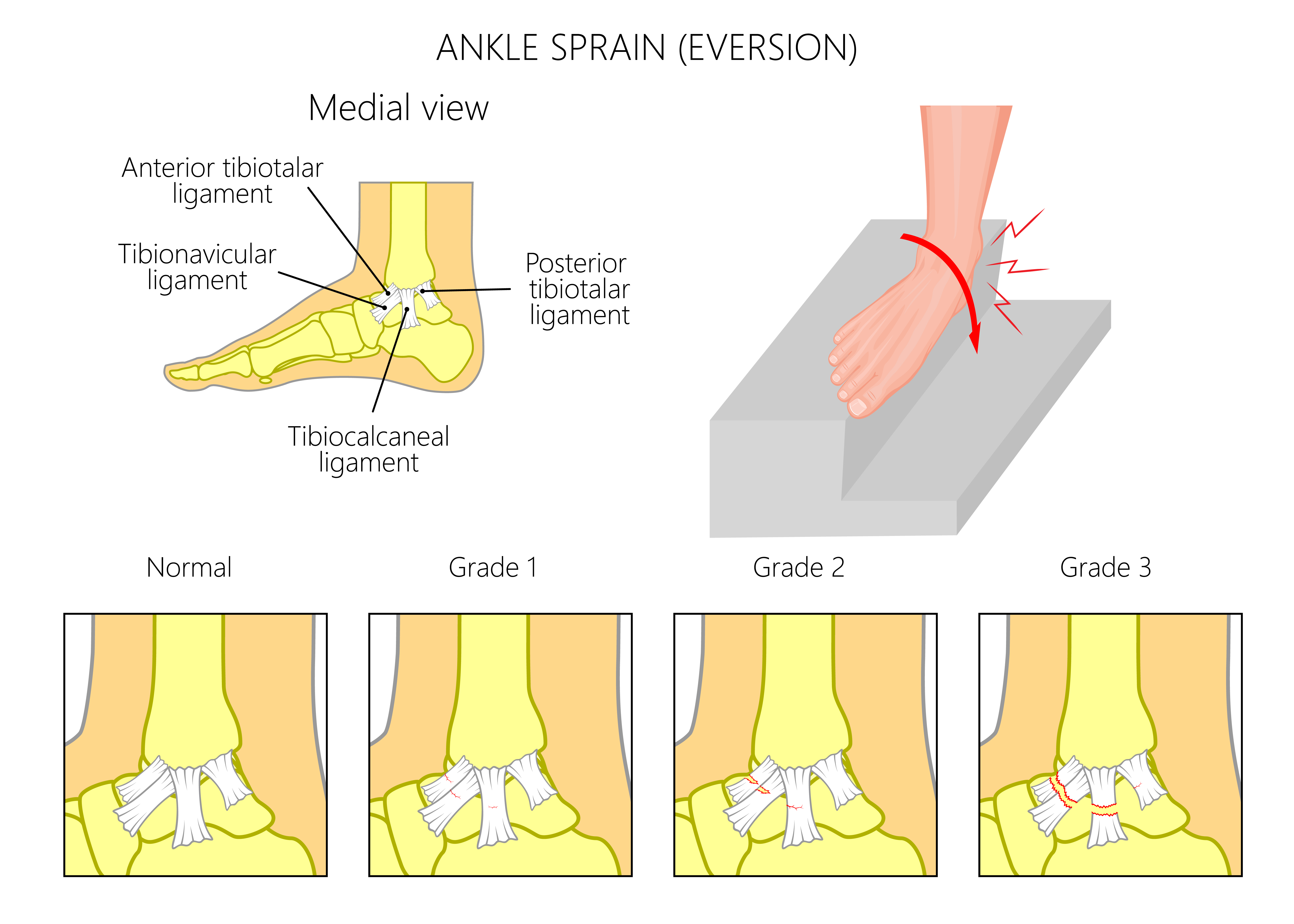 ankle inversion