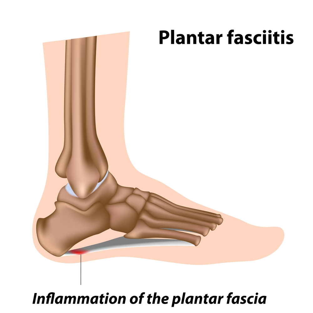 Heel Spurs: Surgery Isn't The “Sole” Solution!