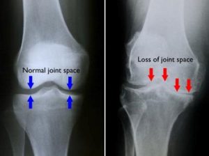 osteoarthritis knee pain