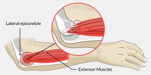 Common Tendon and Soft Tissue Injuries in the Elbow