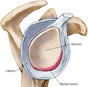 shoulder bankart lesions