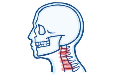 Joint Pain in the Neck