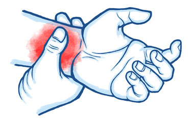 Osteoarthritis in the Hand and Wrist