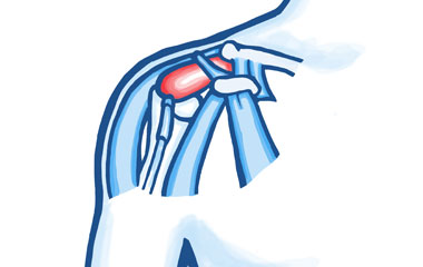 Tendon Problems in the Shoulder Joint