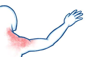 Referred Pain in the Shoulder Joint