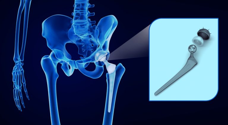 Osteoarthritis in the Hip Joint | Buxton Osteopathy Clinic