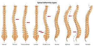 spinal deformity treatment