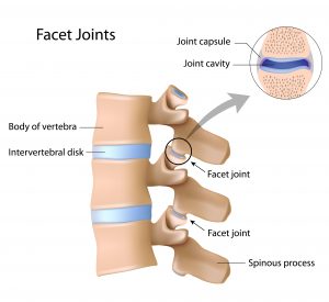facet joint trapped nerve