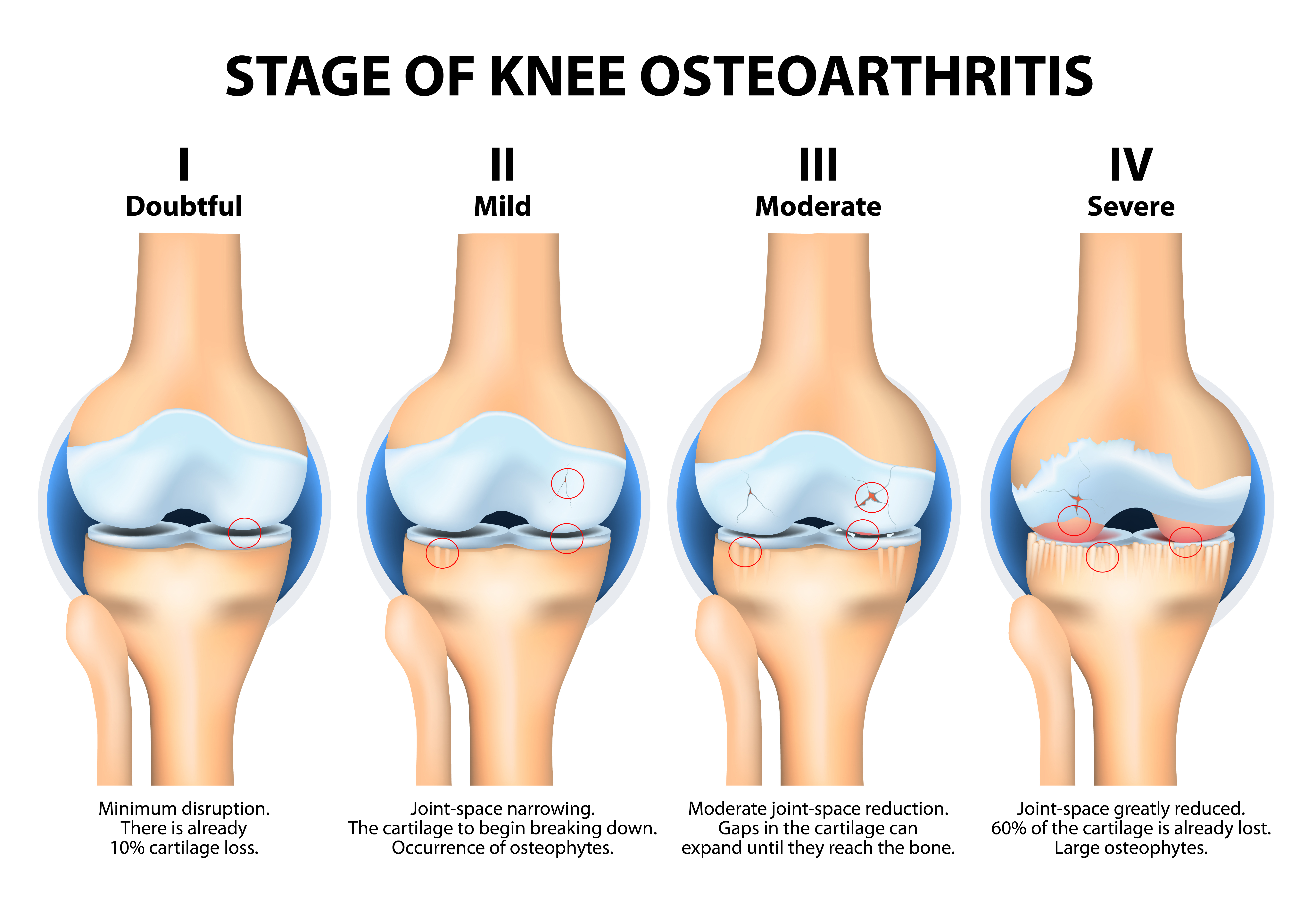На начальном этапе можно. Остеоартрит 1-2 степени. Деформирующий артроз коленного сустава стадии. Деформирующий артроз 2-3 степени коленного сустава. Деформирующий остеоартрит коленного сустава.