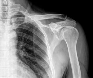 osteoarthitis shoulder AC 