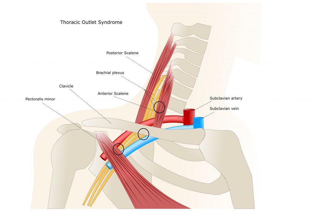 thoracic outlet syndrome armpit pain