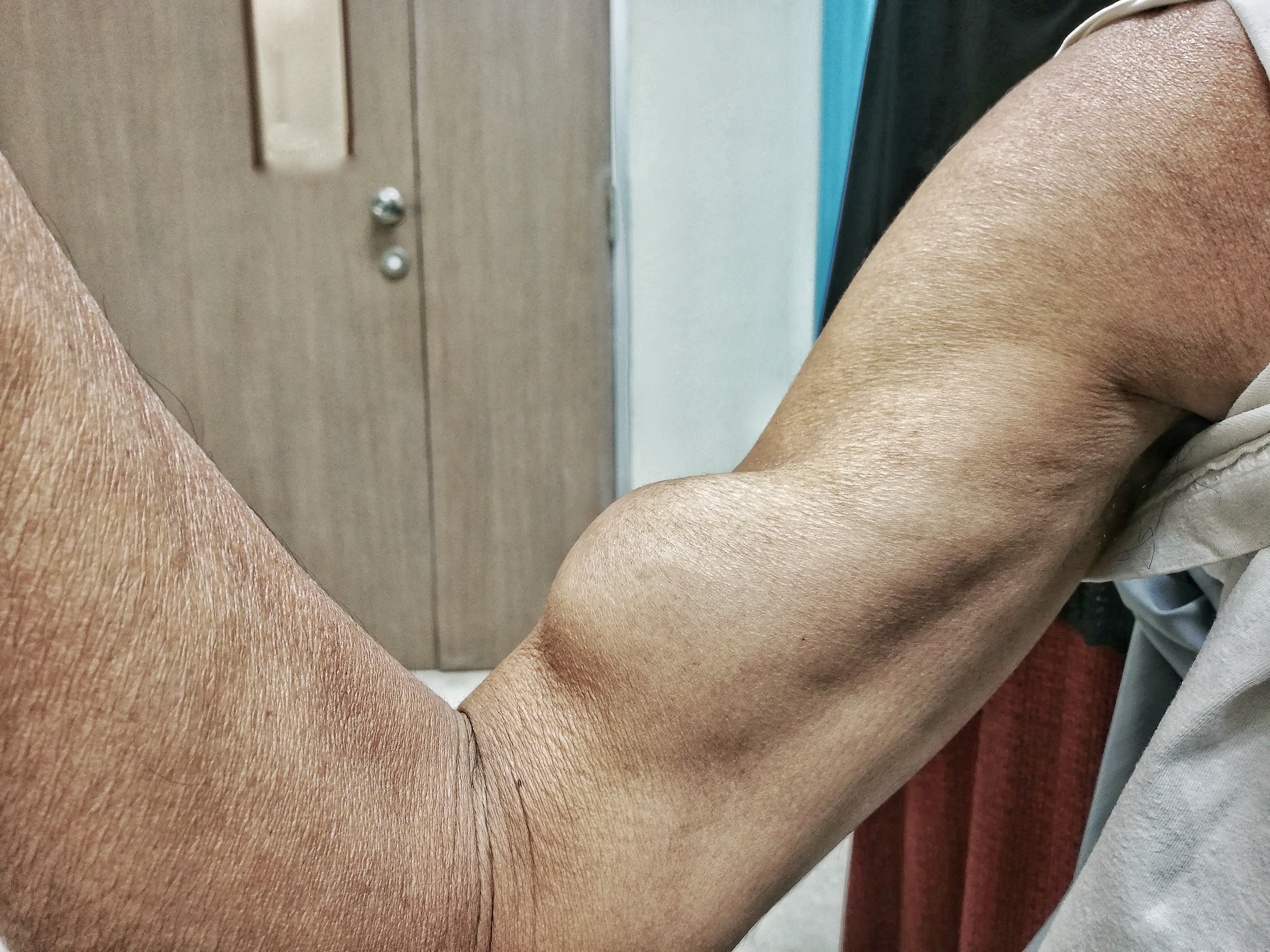 Заболевание мышц рук. Разрыв сухожилия двуглавой мышцы.