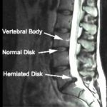 Disc Herniation and Discectomy
