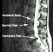 herniated disc trapped nerve