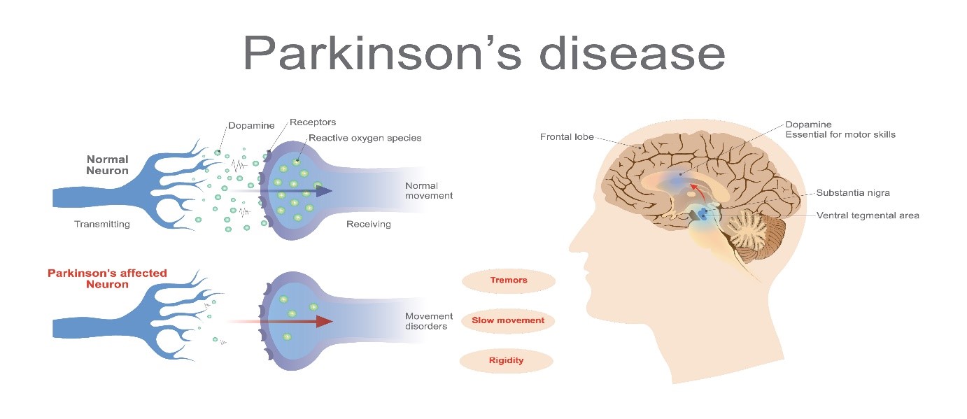 latest research on parkinson disease