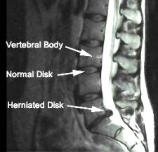 Herniated or Prolapsed Discs