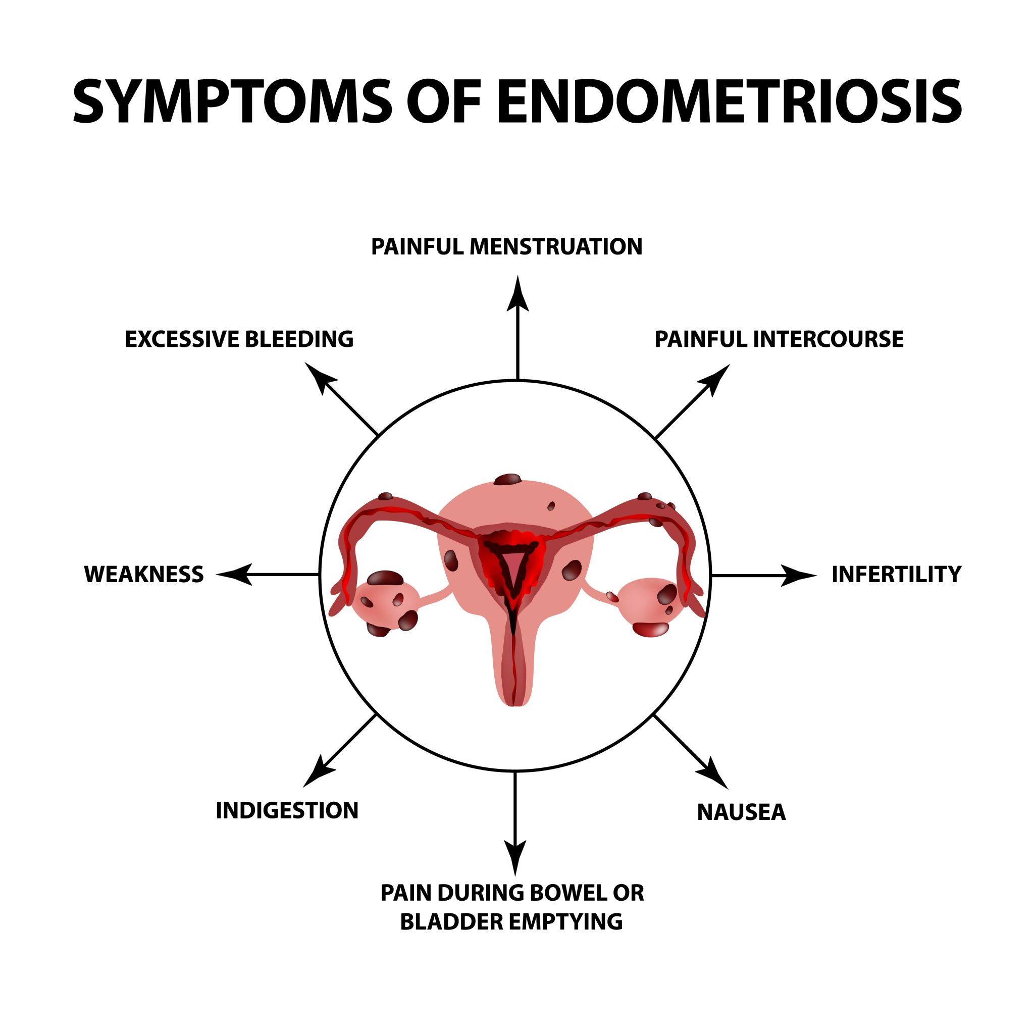 Endometriosis And Latest Prospective Treatment Of Options 7871
