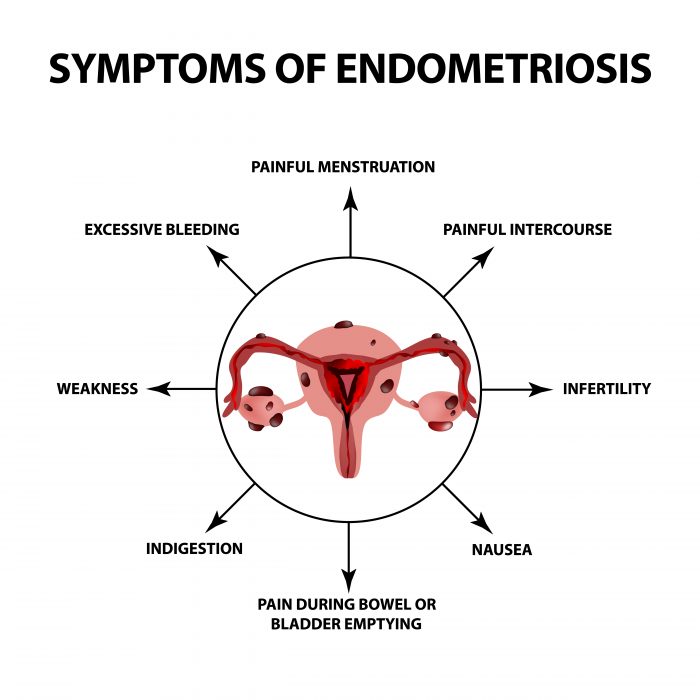 Symptoms of endometriosis