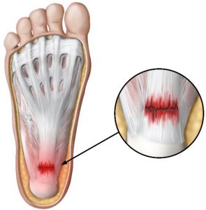 Plantar Fasciitis treatment Derbyshire | Buxton Osteopathy Clinic