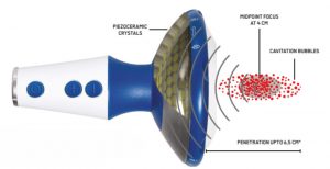 Achilles tendinopathy treatment Peak District Focused Shockwave